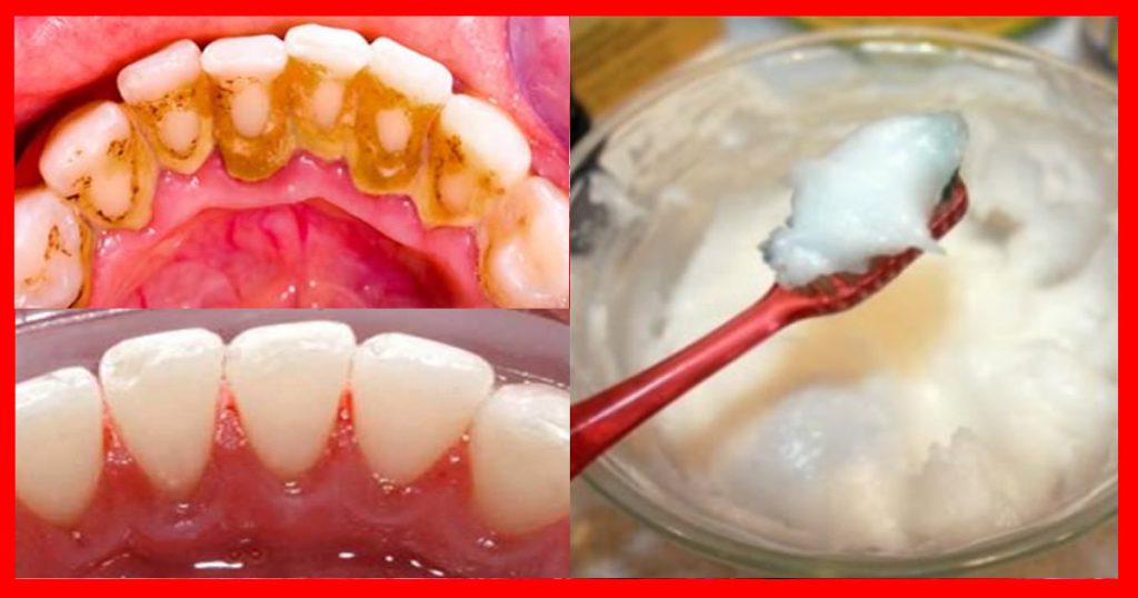 Voici le remède maison le plus efficace pour éliminer le tartre des dents en moins de 5 minutes