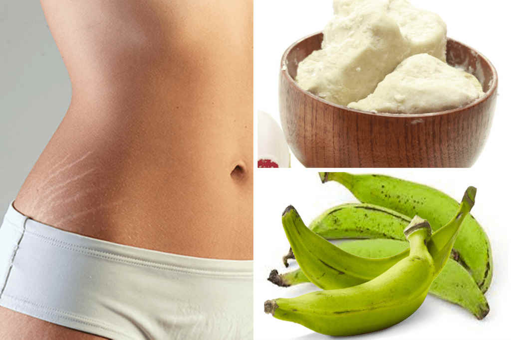 Voici une recette simple et efficace pour éliminer les vergetures