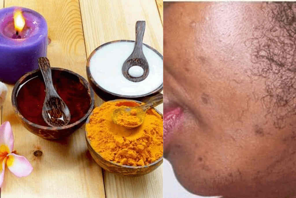 Voici comment utiliser le curcuma et sucre pour vous débarrasser définitivement des poils du visage