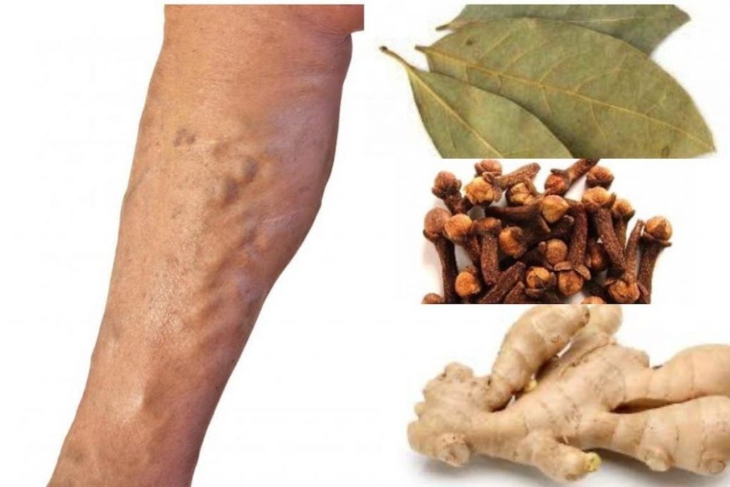 Recette avec les clous de girofle pour lutter contre les varices en seulement 3 jours