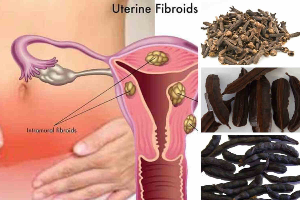 Clou de girofle, poivre africain et 4 cotés, la combinaison miracle contre les fibromes et myomes