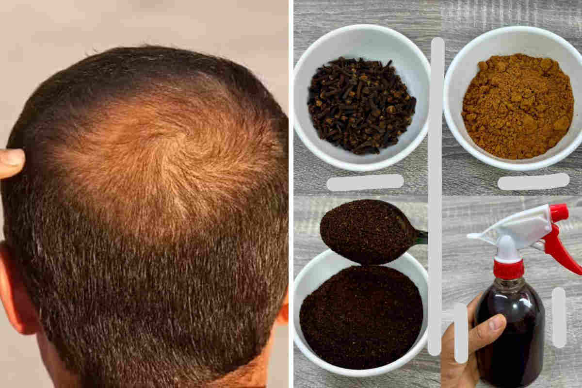 Comment traiter naturellement la calvitie chez l’homme avec le clou de girofle