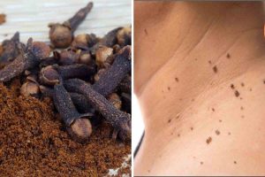 Le secret du clou de girofle pour enlever une verrue en 1 nuit